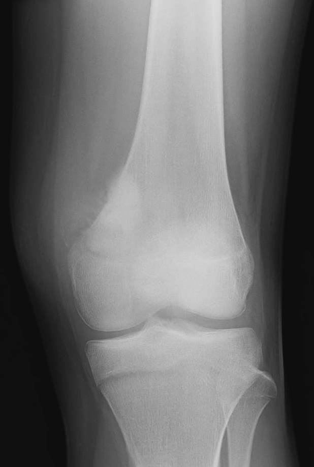 Bone Tumours And Benign Lytic Lesions